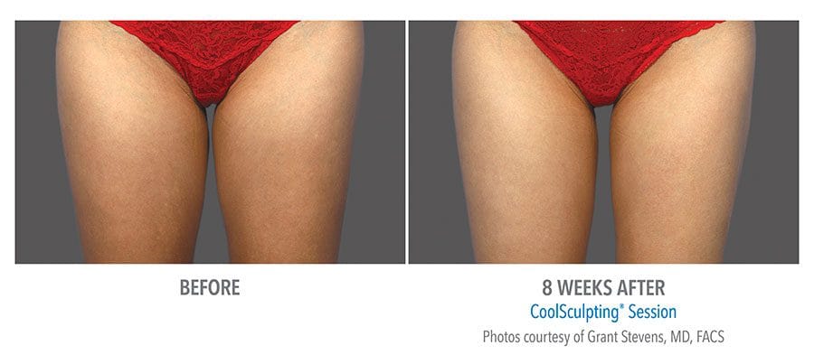 female inner thigh, 2 photo set, front view, 8 weeks