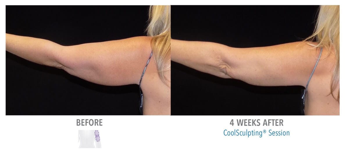 Arms Coolsculpting Cool Sculpting Fat Removal Virginia Beach VA