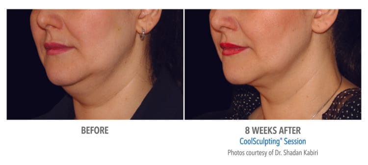 Chin Cool Sculpting Coolsculting Double Chin Removal