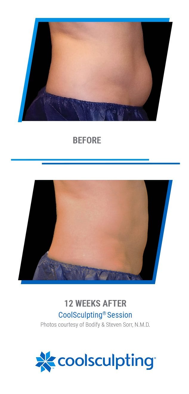 _351464 - CoolSculpting Photos - 1080x1350px v2 - 1