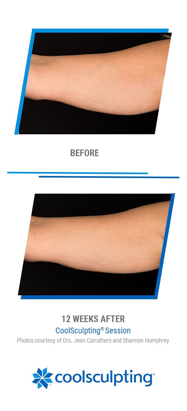 _351464 - CoolSculpting Photos - 1080x1350px v2 - 3