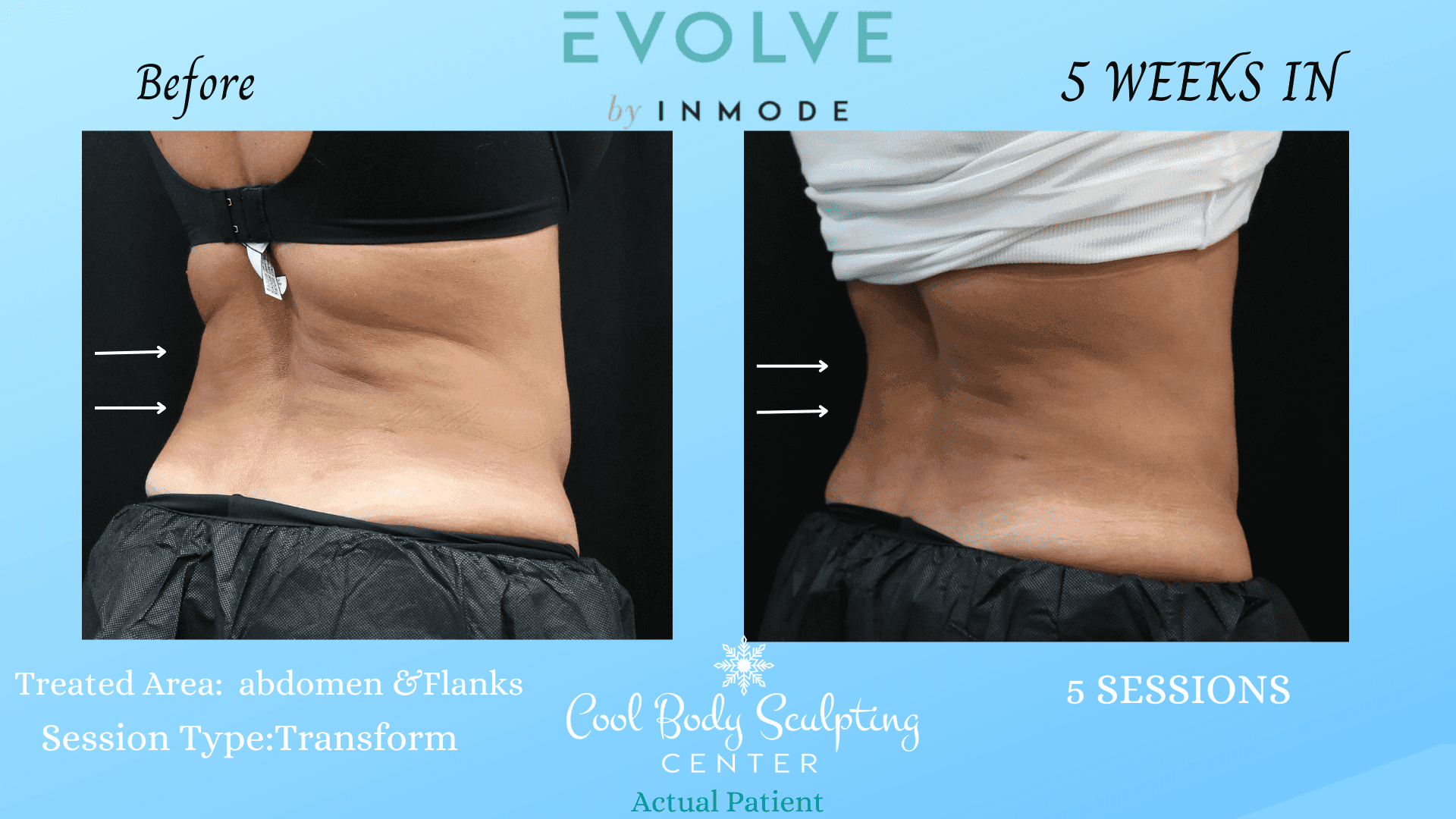 Evolve Results Cool Body Sculpting Center Virginia Beach, VA