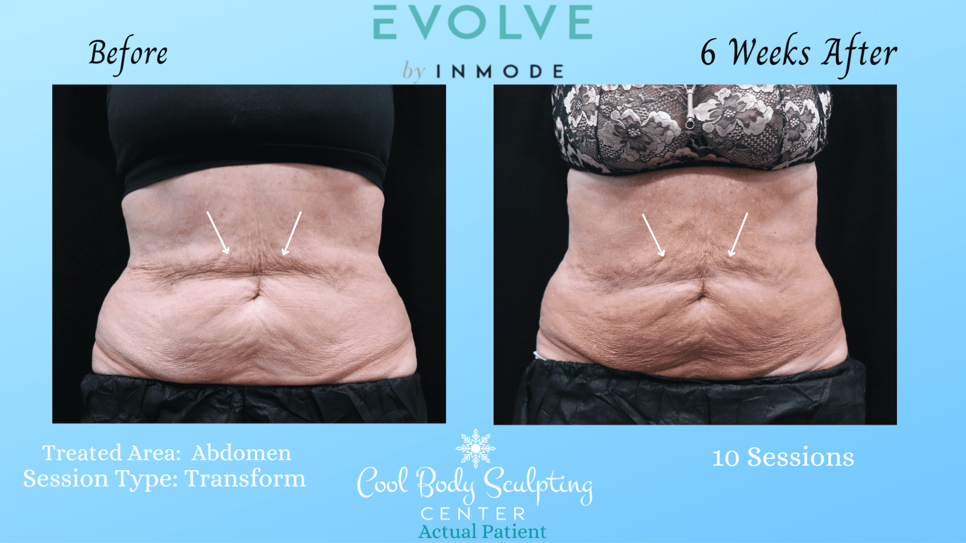 Evolve Results Cool Body Sculpting Center Virginia Beach, VA