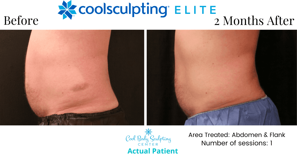 Cool Body Sculpting CenterCoolSculpting Price