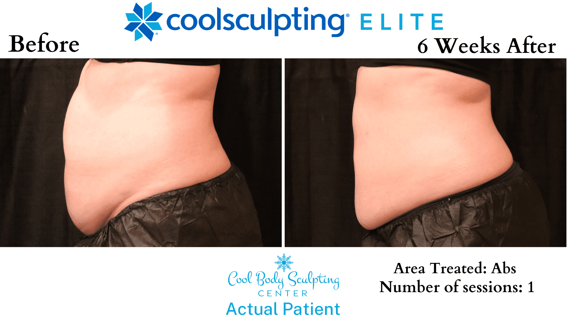 Coolsculpting price, coolsculpting, cool sculpting, coolsculptng near me, cryolipolysis, coolsculpting in virginia beach, coolsculpting cost, cool sculpting cost, coolsculpting before and after, coolsculpting reviews, coolsculpting side effects, coolsculpting results, fat freezing, coolsculpting in Chesapeake, non invasive fat reduction, non surgical fat reduction, body contouring, non surgical body contouring, coolsculpting elite, cool body sculpting, how much is coolsculpting, what is coolsculpting, how much does coolsculpting cost, sono bello nightmare, lipo, 