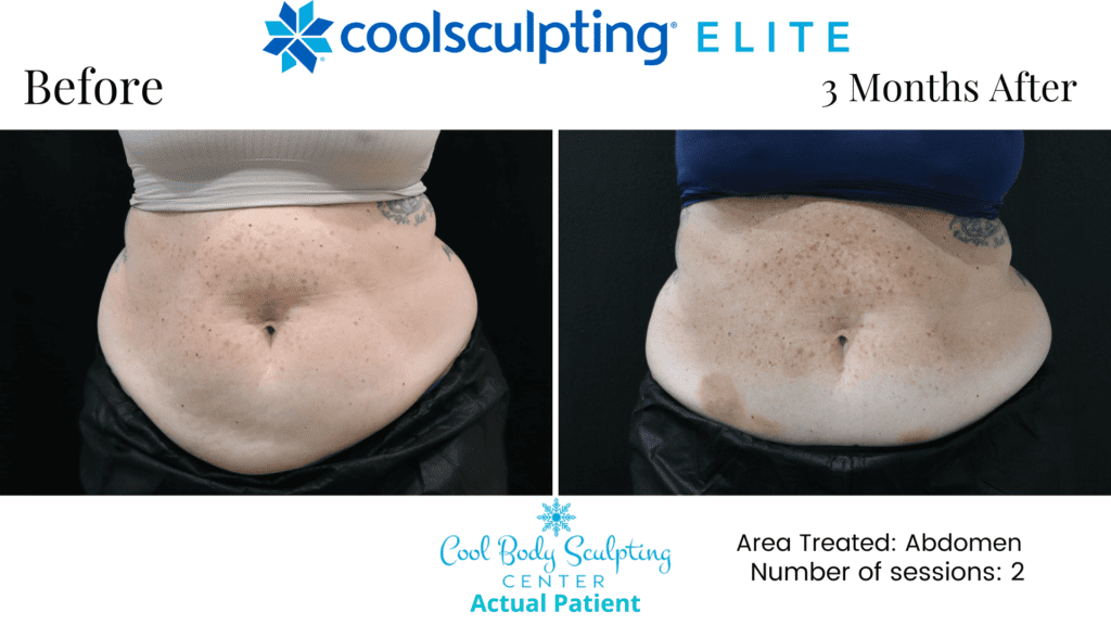 CoolSculpting results in Virginia Beach