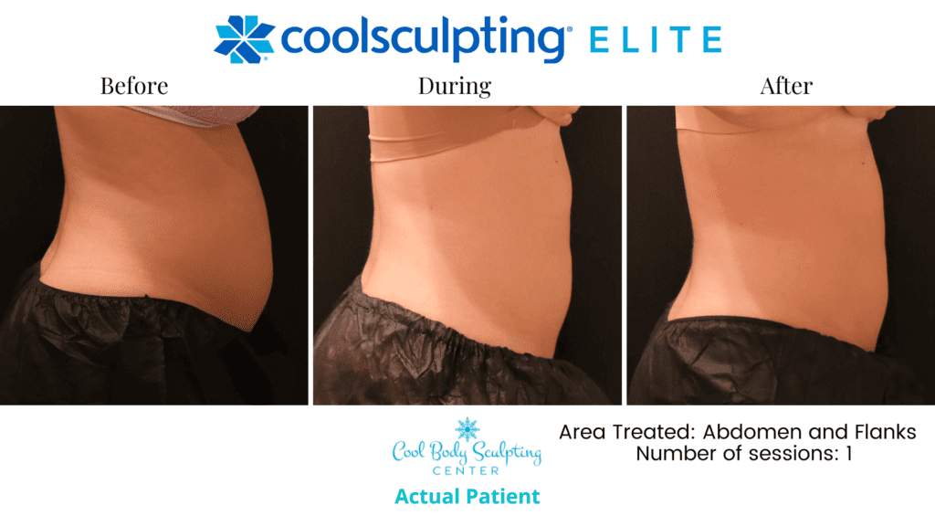 CoolSculpting results in Virginia Beach