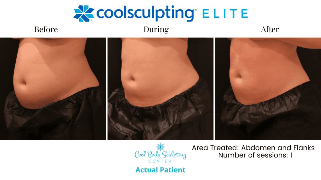 CoolSculpting results in Virginia Beach