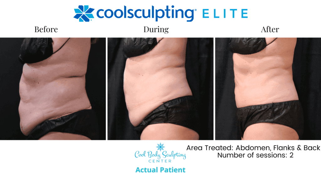 CoolSculpting results in Virginia Beach