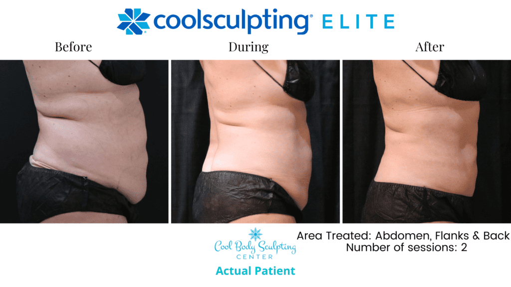 CoolSculpting results in Virginia Beach