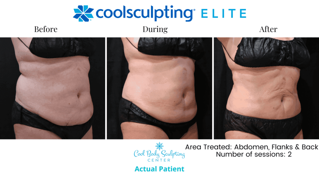 CoolSculpting results in Virginia Beach