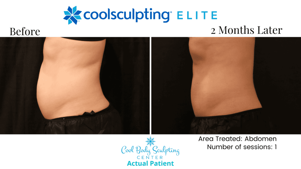 CoolSculpting results in Virginia Beach