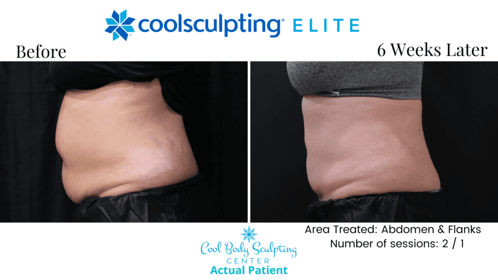 CoolSculpting results in Virginia Beach