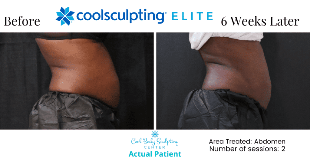 CoolSculpting results in Virginia Beach