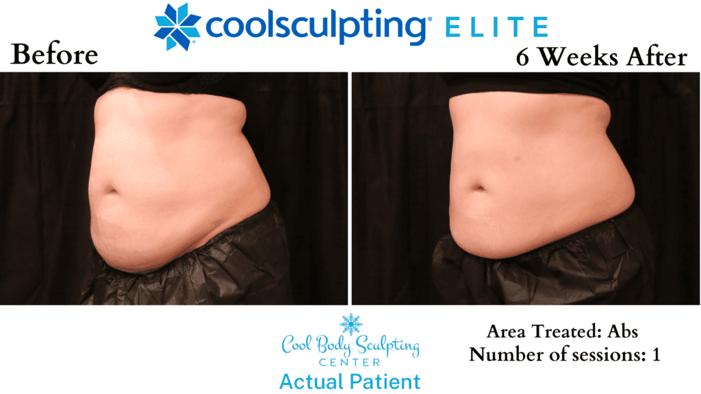 CoolSculpting results in Virginia Beach