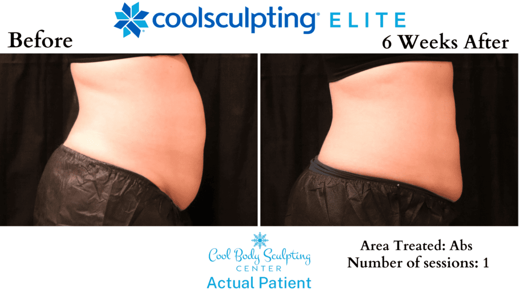 CoolSculpting results in Virginia Beach