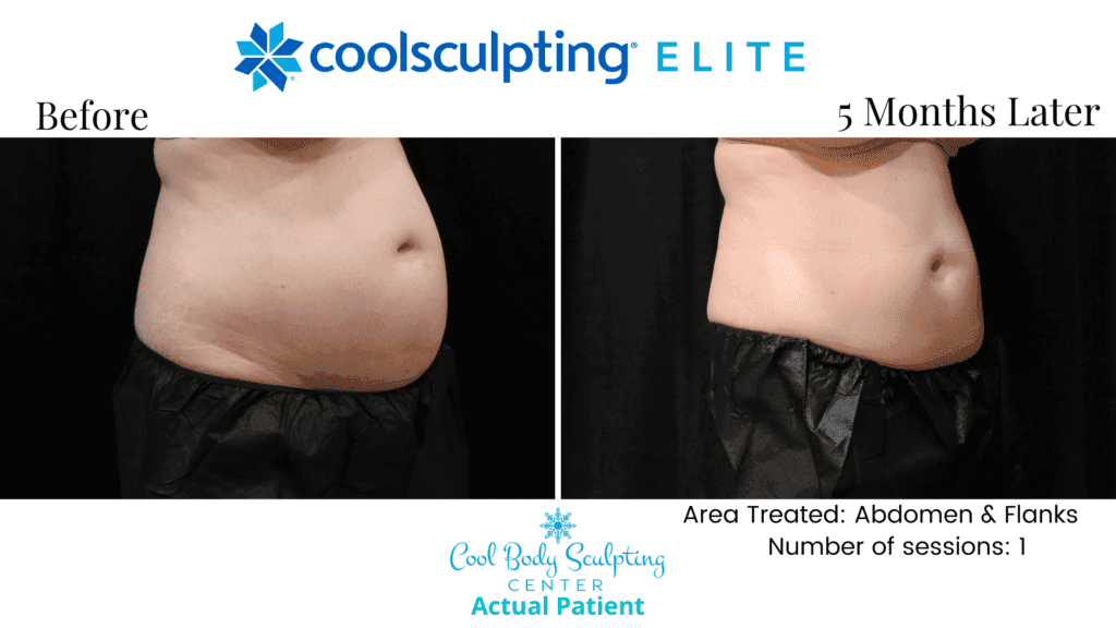 CoolSculpting results in Virginia Beach