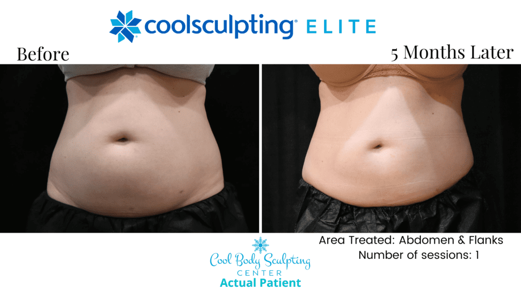 CoolSculpting results in Virginia Beach