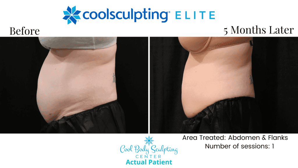 CoolSculpting results in Virginia Beach