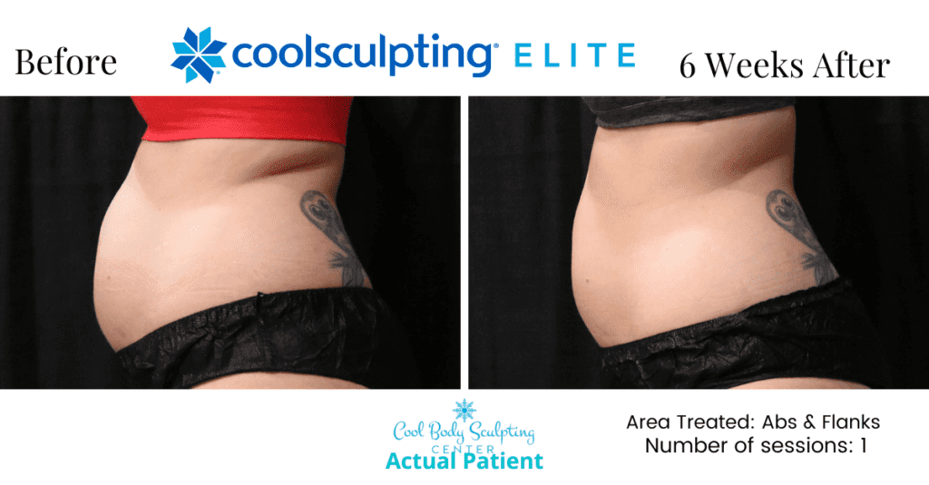 CoolSculpting results in Virginia Beach