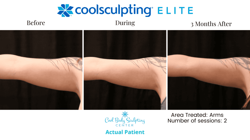 CoolSculpting in Virginia beach