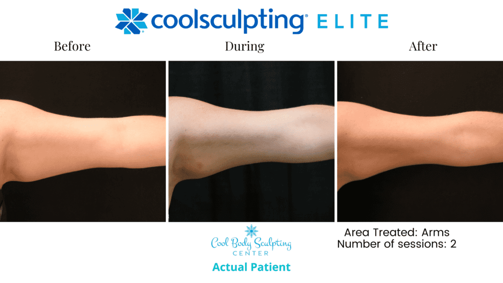 CoolSculpting in Virginia beach