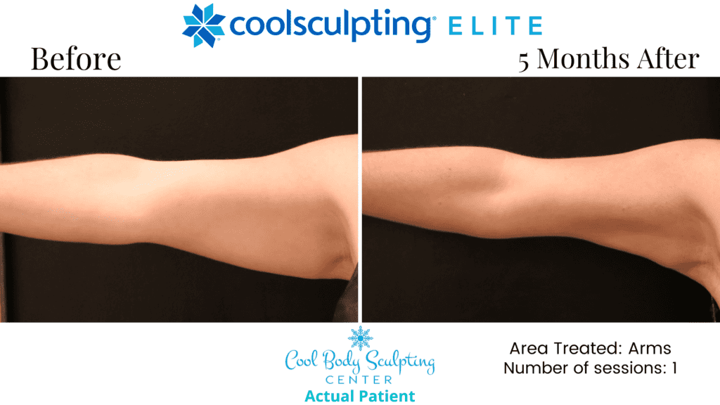 CoolSculpting in Virginia beach