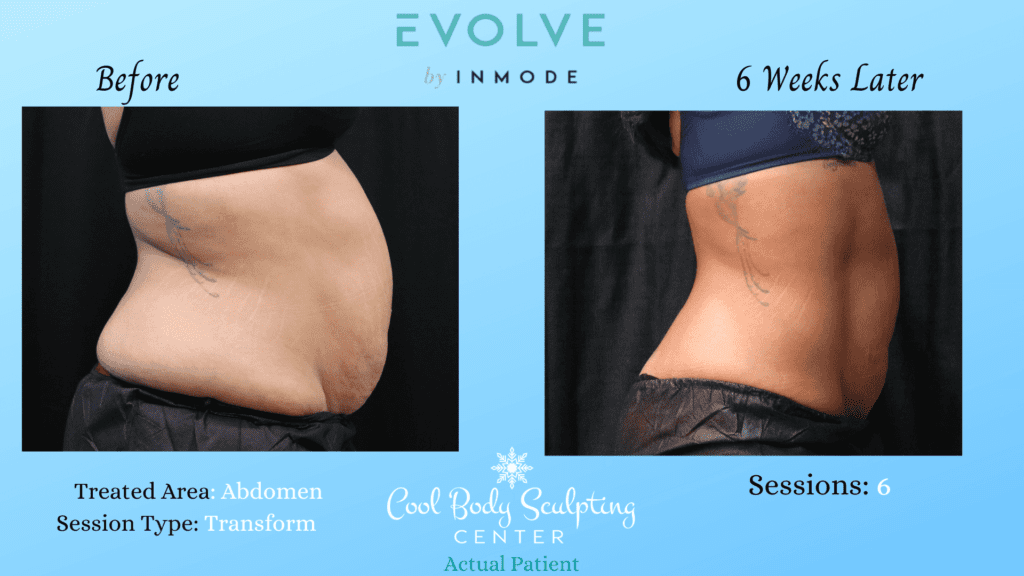 Body contouring results