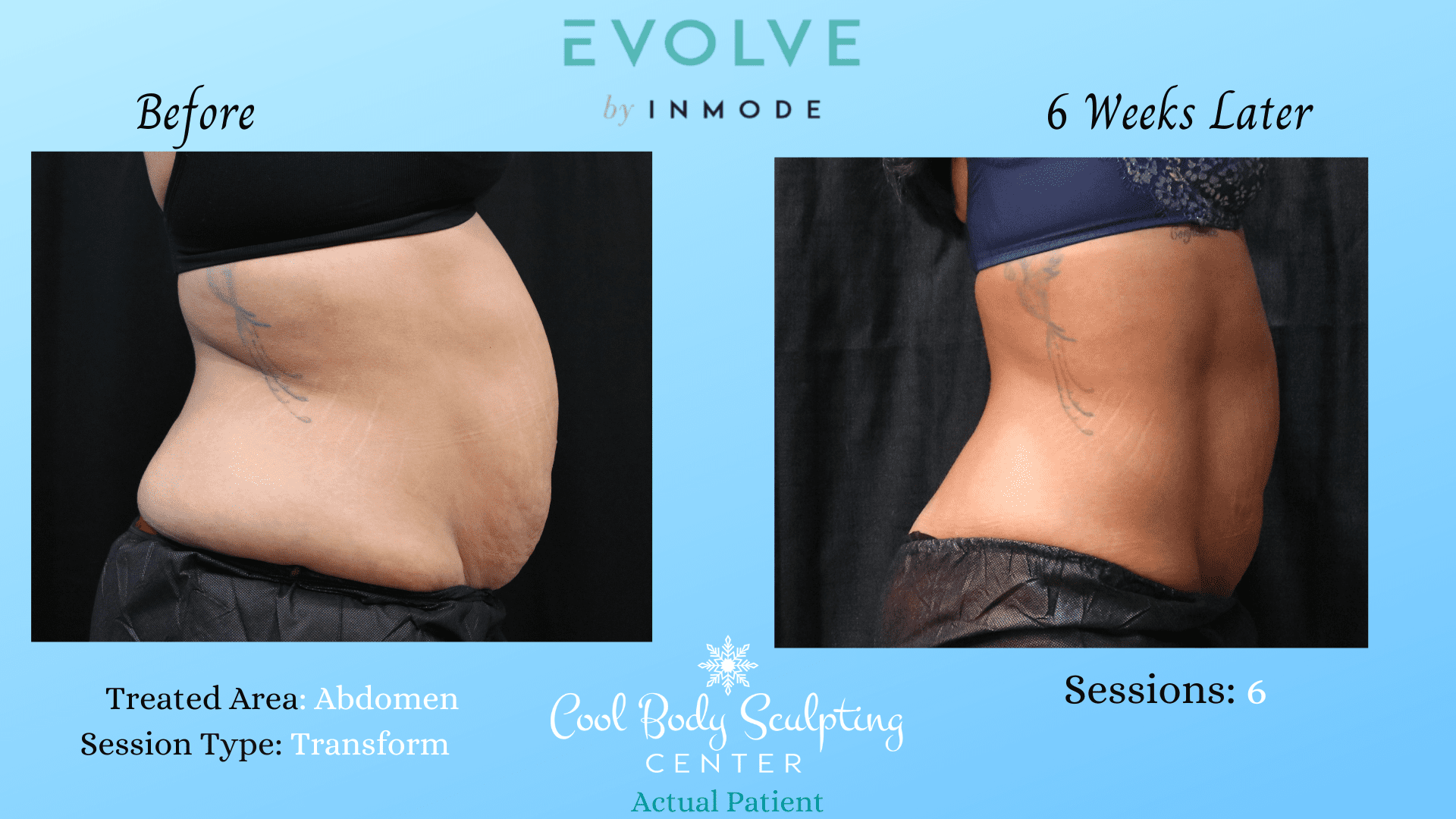 Body contouring results