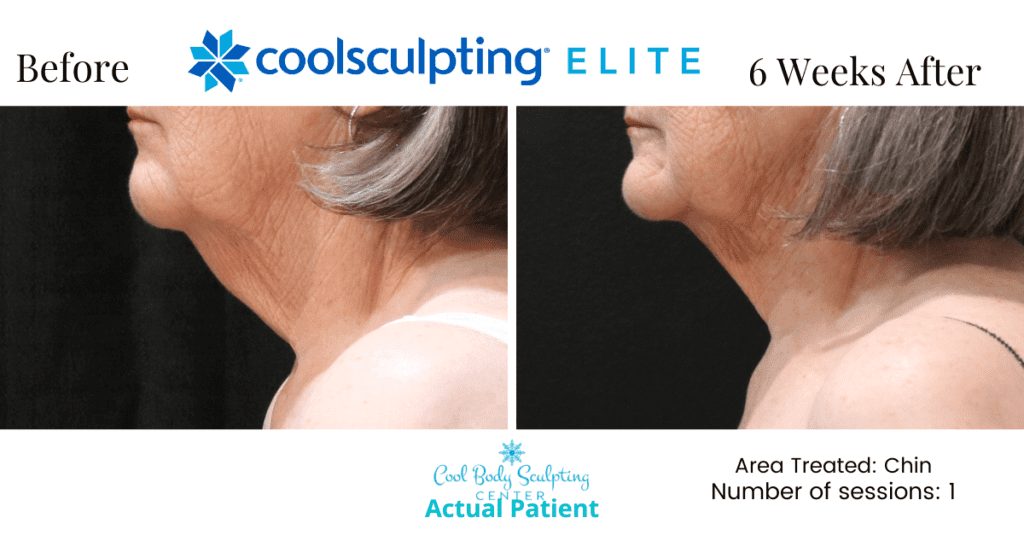 cool sculpting results